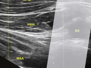 Libro Abordaje Infraclavicular By Mario Fajardo