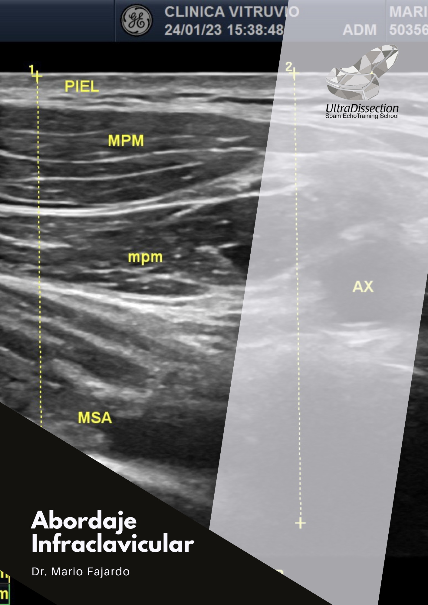 Libro Abordaje Infraclavicular By Mario Fajardo