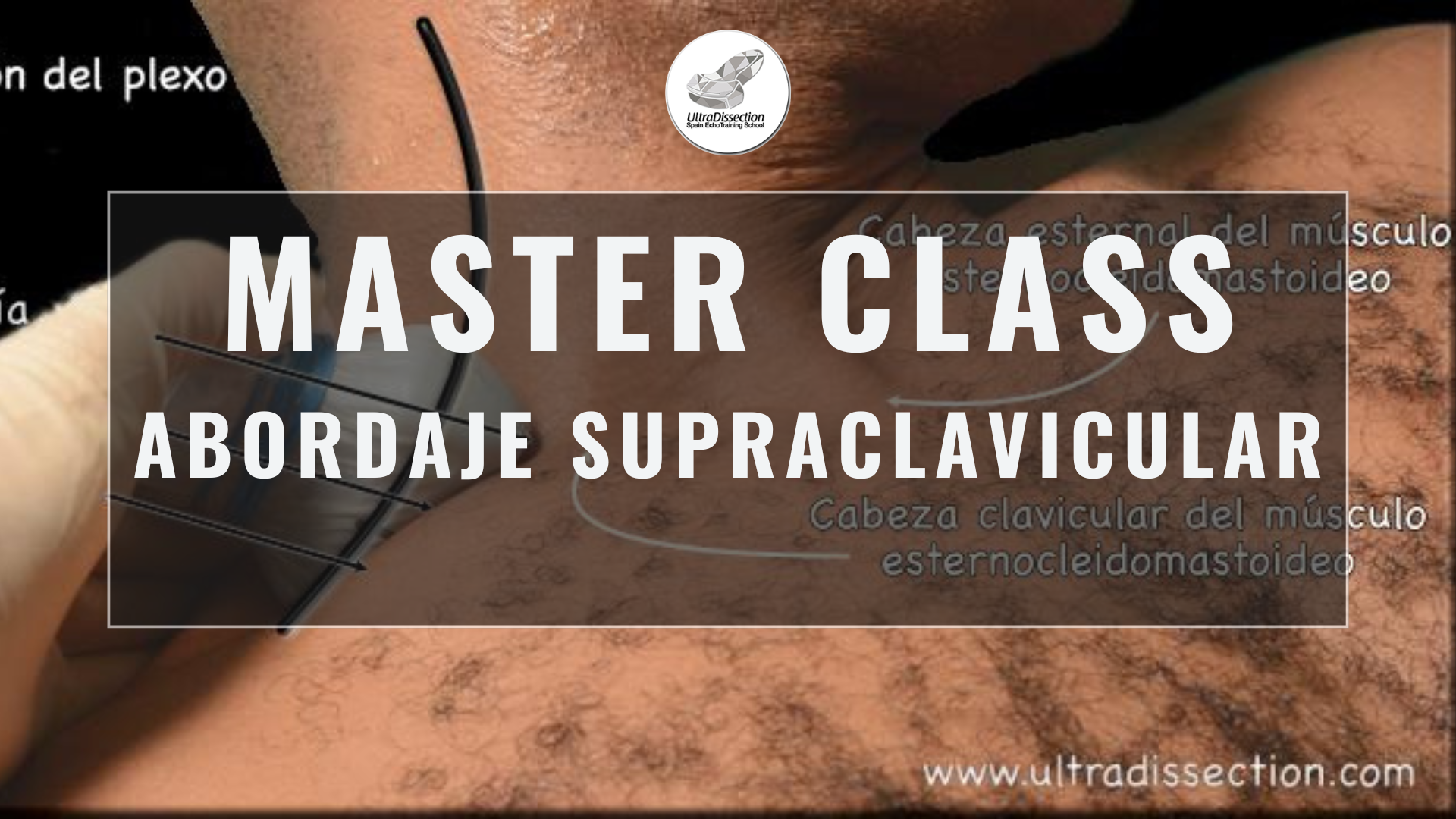 Masterclass 34 | Abordaje supraclavicular – 2